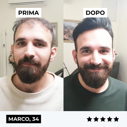 CURENSE - Sistema di micro-infusione per la ricrescita dei capelli