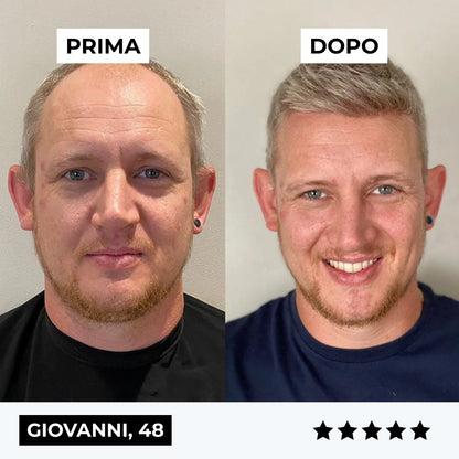 CURENSE - Sistema di micro-infusione per la ricrescita dei capelli