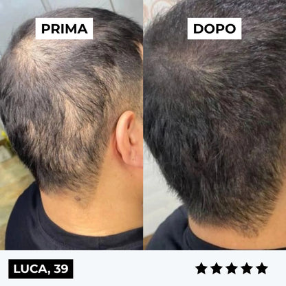 CURENSE - Sistema di micro-infusione per la ricrescita dei capelli
