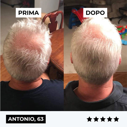 CURENSE - Sistema di micro-infusione per la ricrescita dei capelli