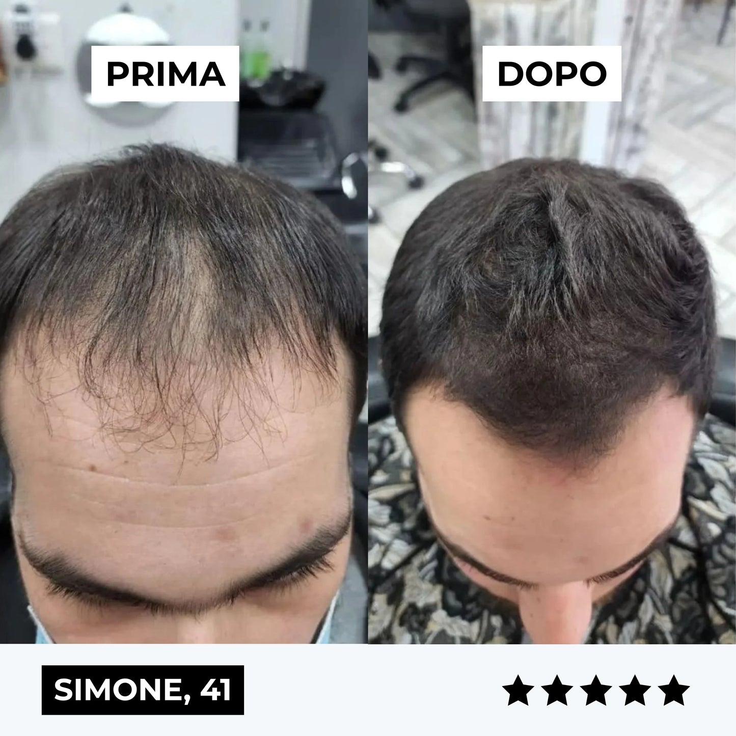 CURENSE - Sistema di micro-infusione per la ricrescita dei capelli