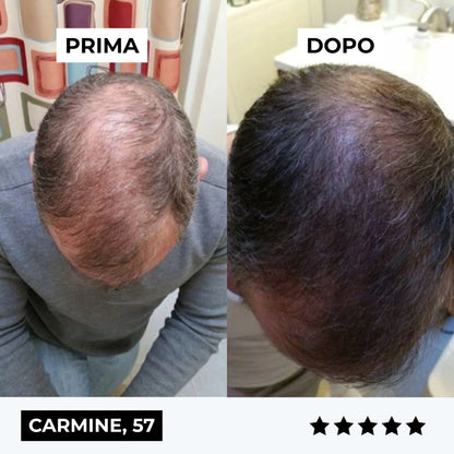CURENSE - Sistema di micro-infusione per la ricrescita dei capelli
