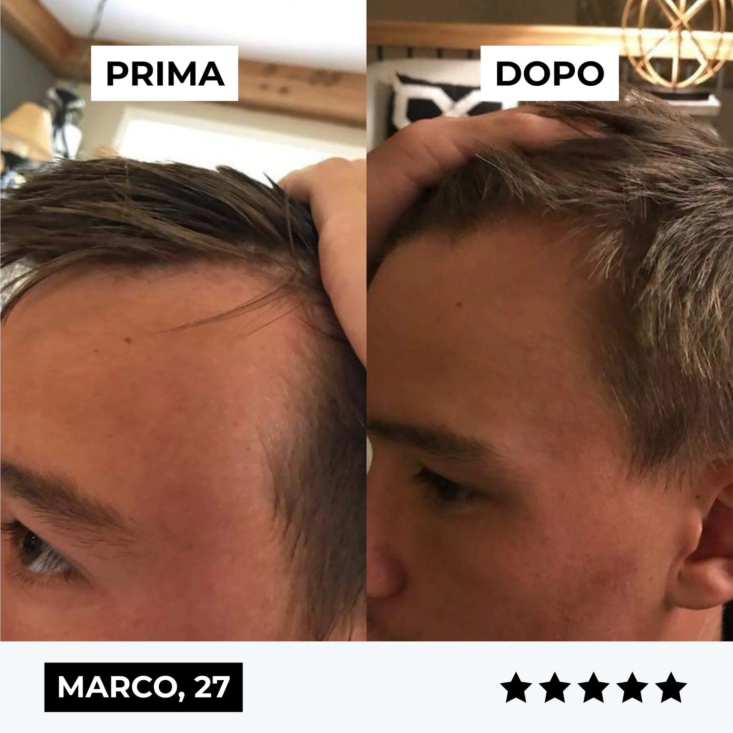 CURENSE - Sistema di micro-infusione per la ricrescita dei capelli