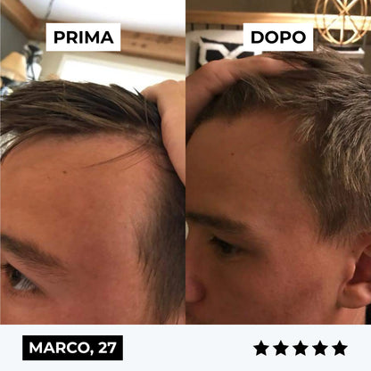 CURENSE - Sistema di micro-infusione per la ricrescita dei capelli