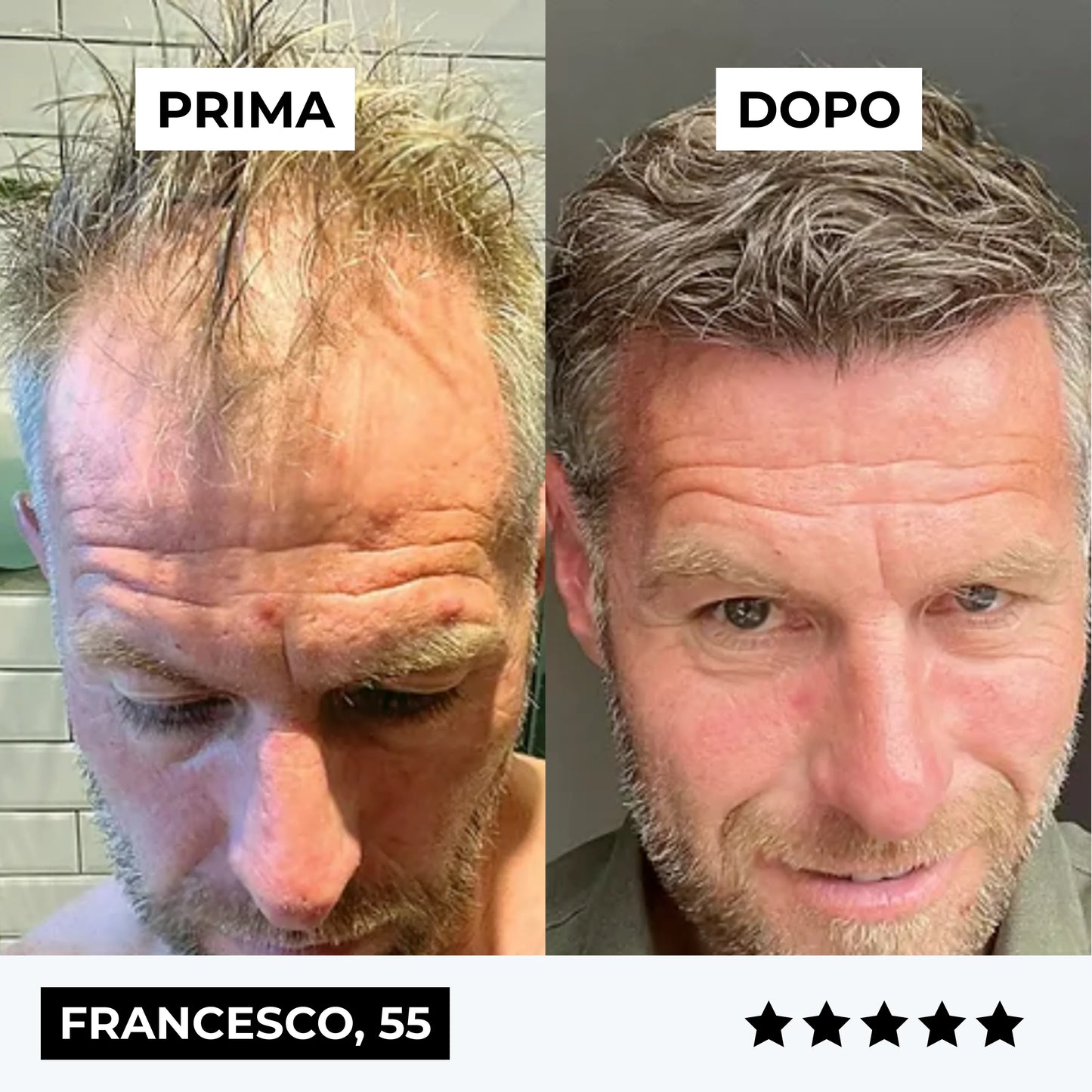 CURENSE - Sistema di micro-infusione per la ricrescita dei capelli